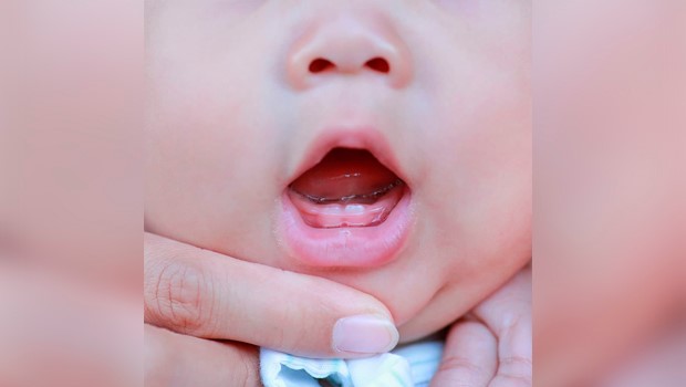 Dientes natales y neonatales