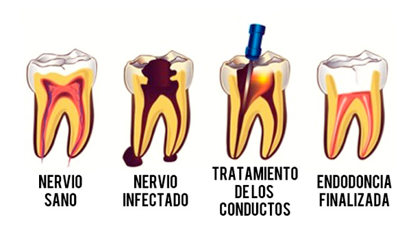 Endodoncia I