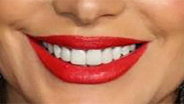 Estética Bucal