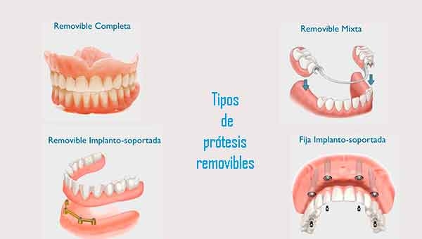 Prótesis dentales