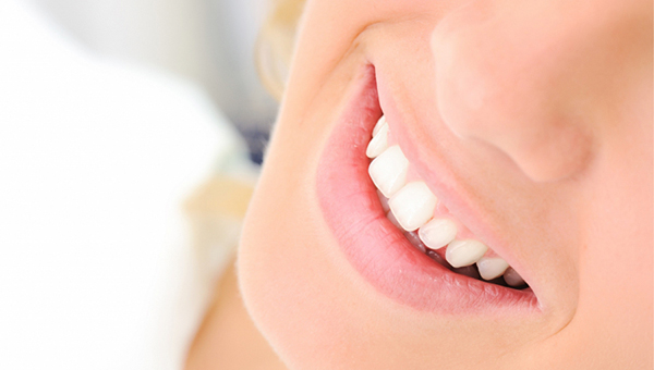 Blanqueamiento dental IV